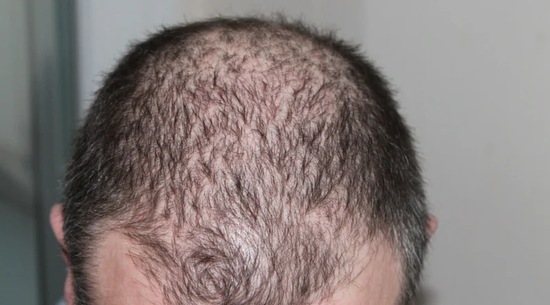 Alopecia: Causas, Tipos e Opções de Tratamento